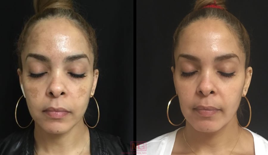 How long do dark spots take to fade on face: real timeline