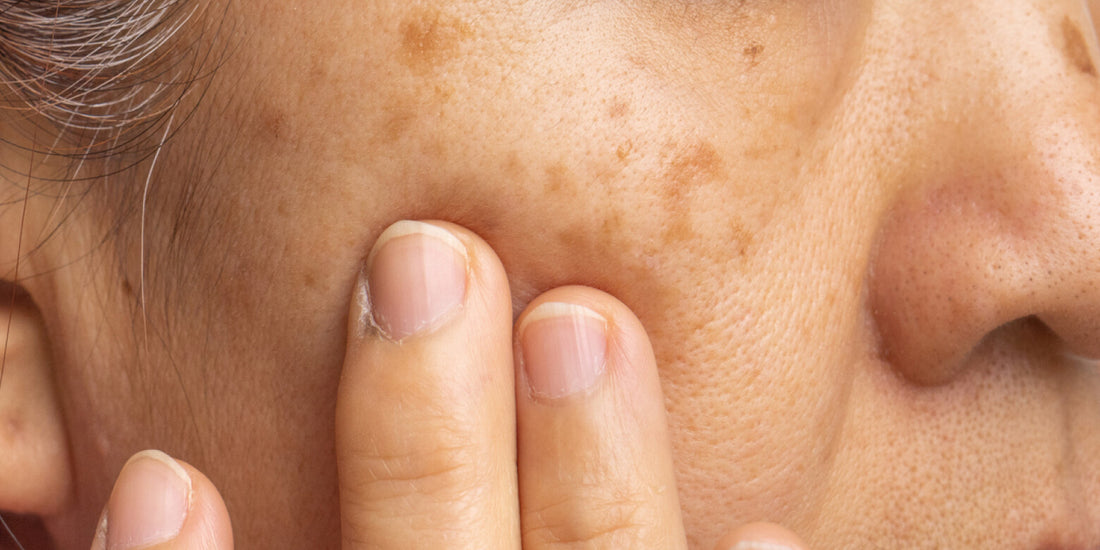 What causes brown spots on skin and how to treat them