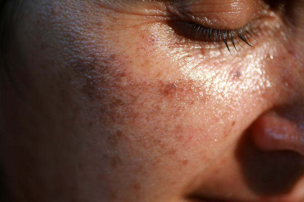 What causes 90% of skin wrinkles: sun exposure and photoaging