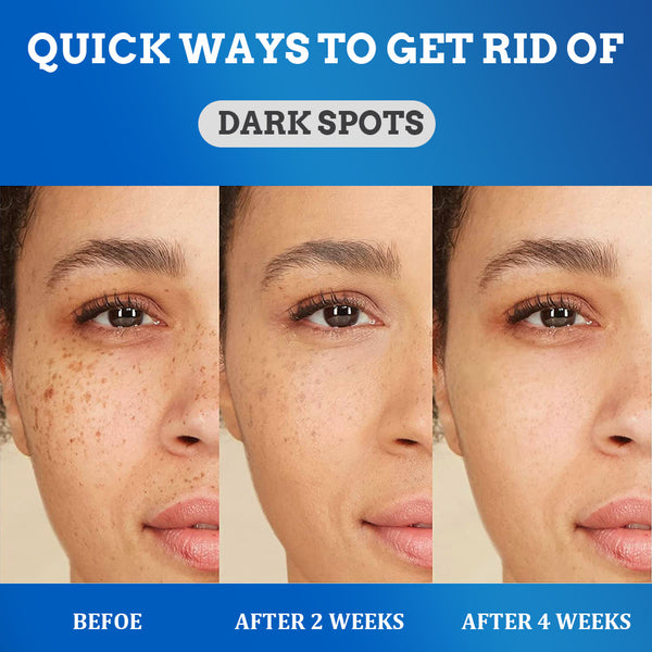 Crème anti tâches brune